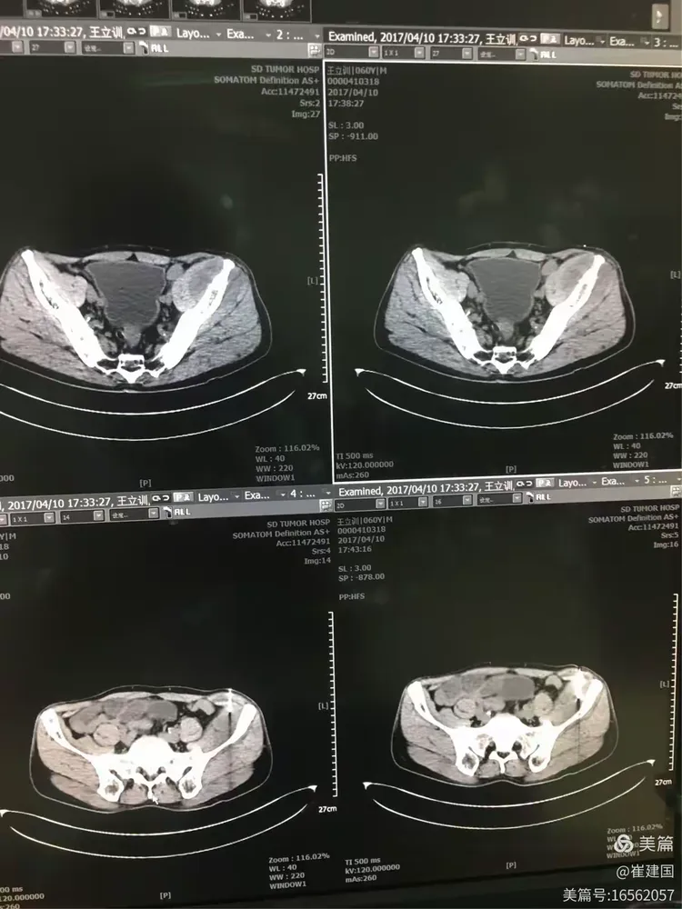 北京大学肿瘤医院穿刺预约-北大肿瘤医院穿刺大夫谁最好 