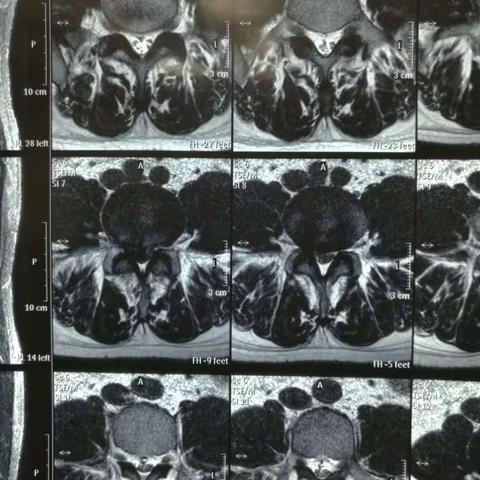 腰4/5椎间盘突出，后纵韧带钙化，椎间孔镜下髓核摘除，椎间孔扩大成形减压，神经根松解（进修学习资料）