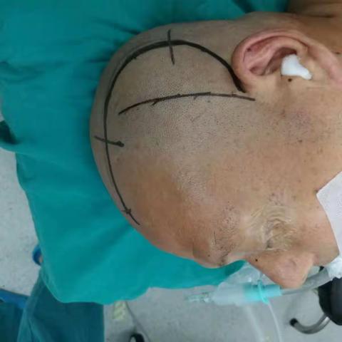 颅内外动脉吻合，颞肌贴敷，脑膜翻转治疗烟雾综合征。