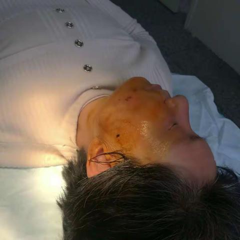 三叉神经痛上颌神经阻滞