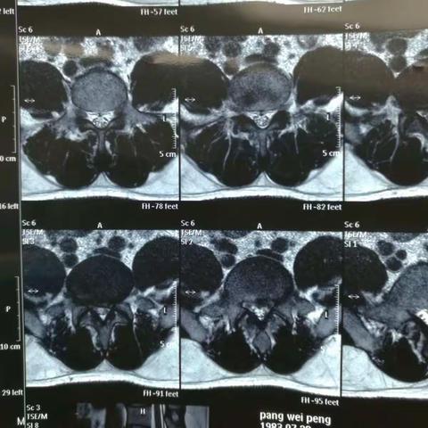 腰5骶1椎间盘突出，椎间孔镜下髓核摘除术（进修学习资料）