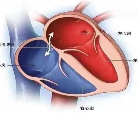 右心声学造影联合经颅多普勒超声发泡实验（心脑同步发泡试验）——由脑到心的侦察兵