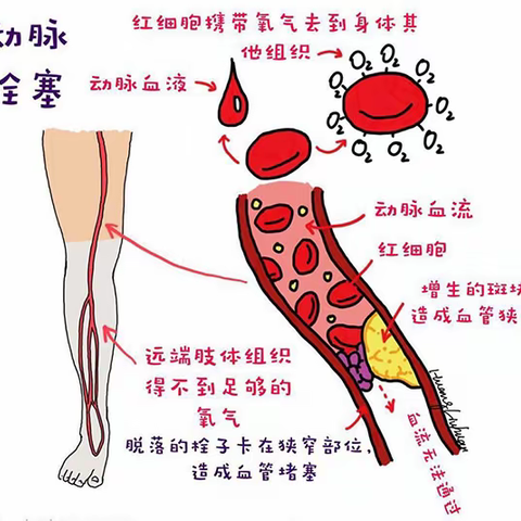 急性下肢动脉栓塞原因及治疗
