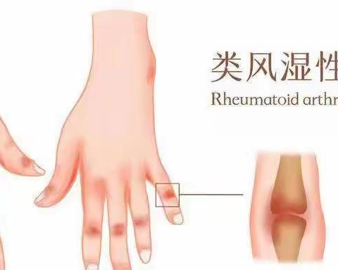 类风湿性关节炎疾病健康教育