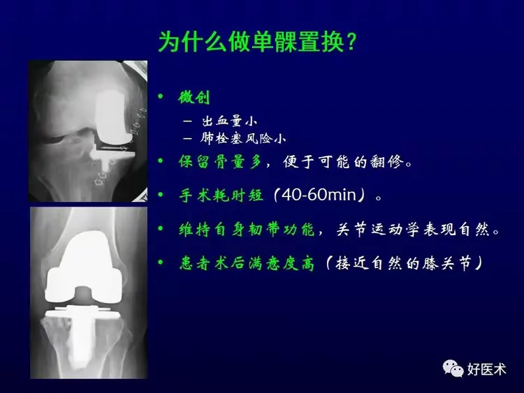 膝关节单髁置换术