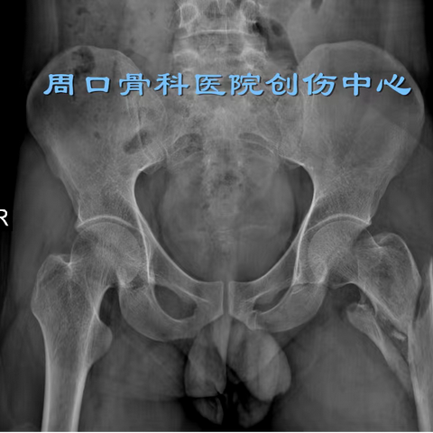 股骨转子下骨折病例分享