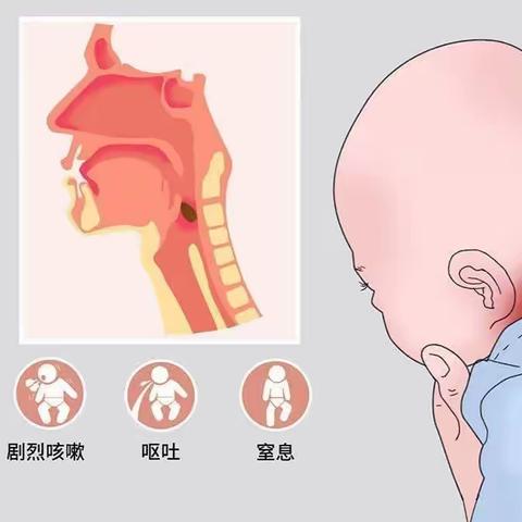 【市妇保院 耳鼻喉科】———喉异物