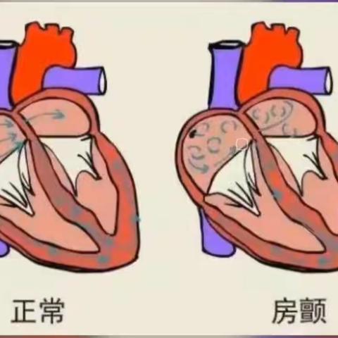 了解心房颤动