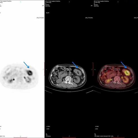 让肿瘤无处遁形的利器--- PET-CT