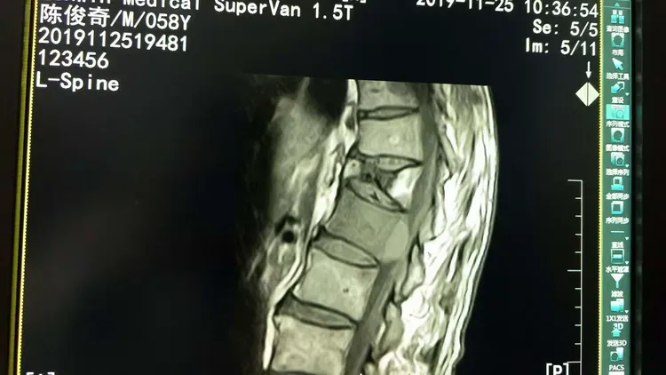 久治不愈的腰痛一一警惕肿瘤