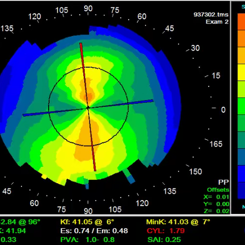 孩子验光没散光，为什么验配OK镜需要配散光片呢？