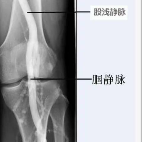 静脉曲张都需要深静脉造影这个检查么？