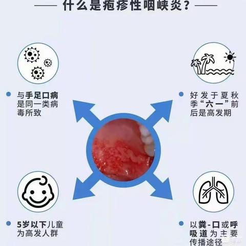 疱疹性咽峡炎预防小提示