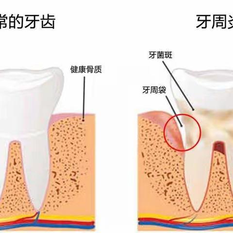 不疼不痒的牙周病正在慢慢“毁掉”我们的牙齿