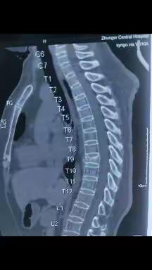 脊柱骨折治疗后是一种什么体验