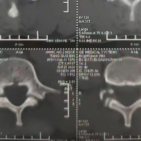 腰椎峡部裂腰椎滑脱最全解析