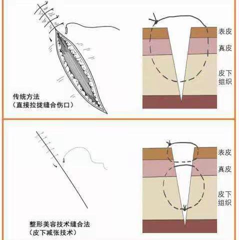 南石医院烧伤瘢痕康复科－细针细线就是美容缝合吗？