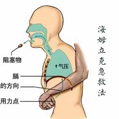 【红烛先锋】安全教育——乌达区第三幼儿园“海姆立克急救法”安全教育活动