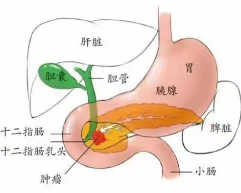 首例！铜川矿务局中心医院成功实施超声引导下经皮胰腺穿刺活检术