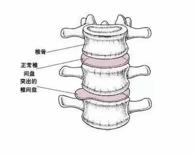 腰椎间盘突出那些事！