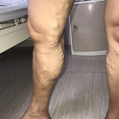 一例静脉曲张患者的诊疗过程