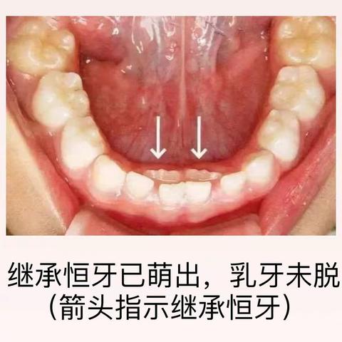 10个孩子里5个长双排牙，医生感叹：都是家长喂出来的