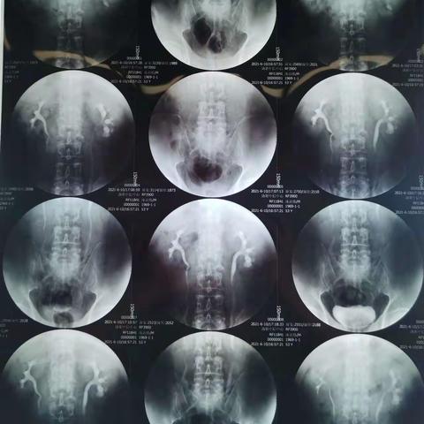 “肾脏积水少，可视肾镜少不了”