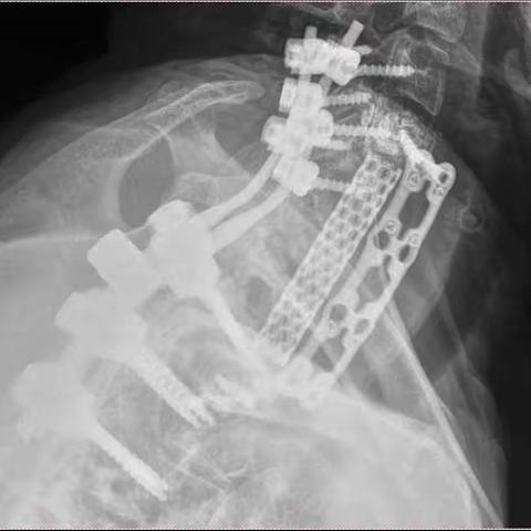 颈胸椎交界多节段椎体切除与重建病人一例