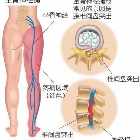 电脑牵引床治疗腰椎间盘突出症