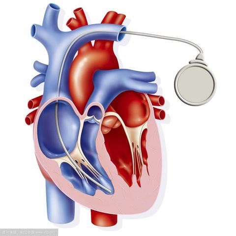 医师节献礼 首例双腔起搏器顺利安装～新技术开启新篇章