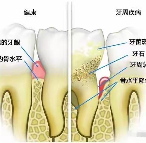 爱牙的警告：牙周炎不治疗的后果