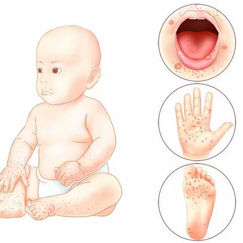 手足口病预防小知识