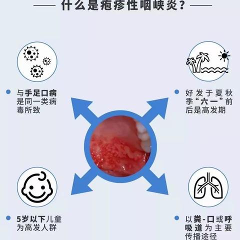 如何预防疱疹性咽颊炎