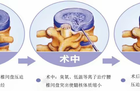 罗平妇康骨友医院最新引进低温等离子微创消融术治疗腰椎间盘突出症——— 微创，快速，效果好