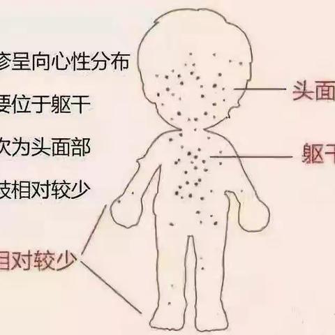 严防春季传染病——水痘