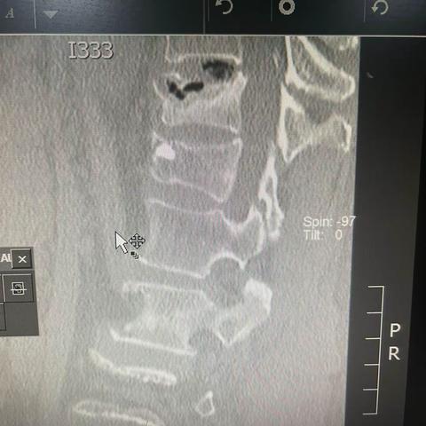 椎体成形术遇到硬化带打不了水泥