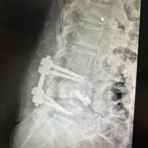 腰椎短阶段固定失败病例