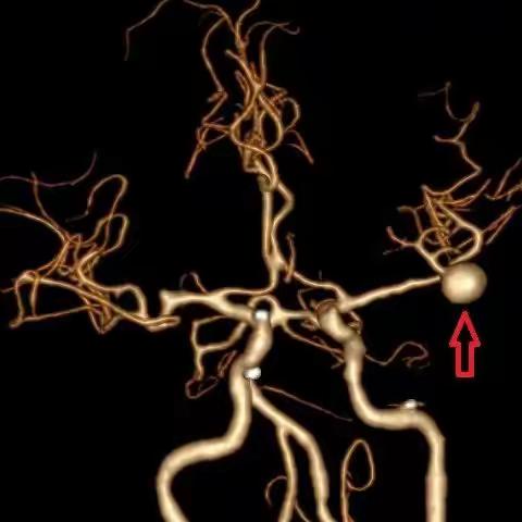 左侧大脑中动脉瘤夹闭并血管重建