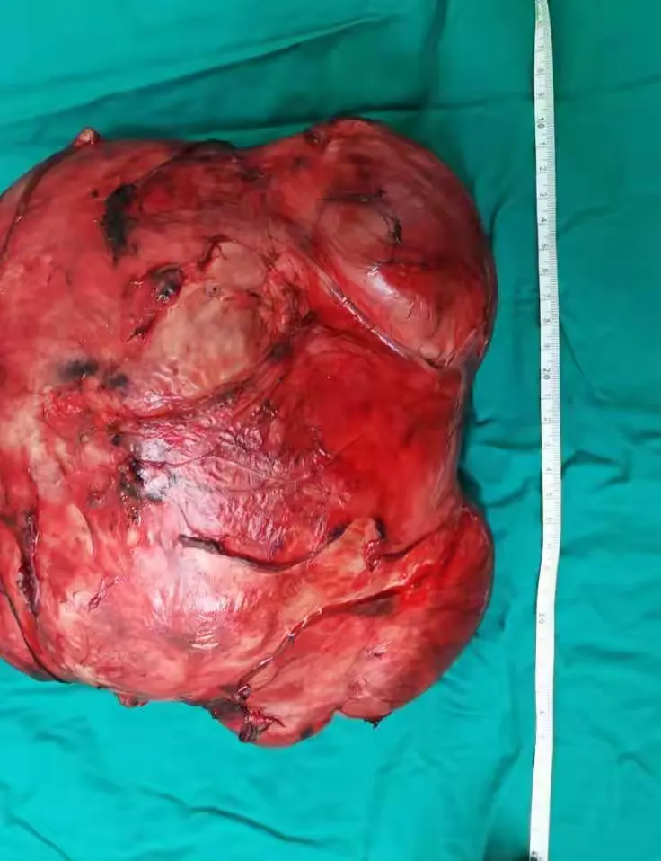 兰州大学第一医院小儿外科成功完成一例小儿巨大肾母细胞瘤切除术