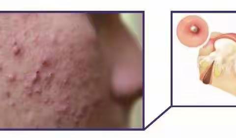 科普：满脸的痘痘，怎么办？