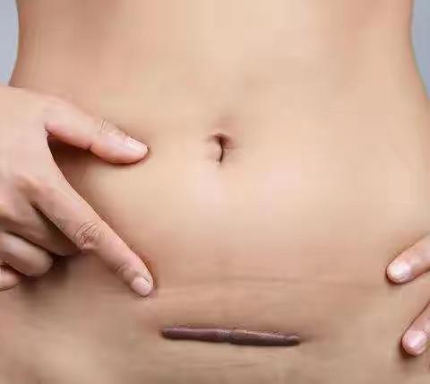 科普：剖腹产疤痕怎么办？