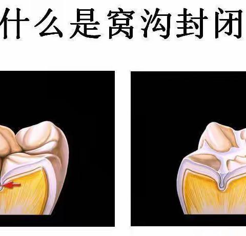 “窝沟封闭”进校园——208班第14周校园活动