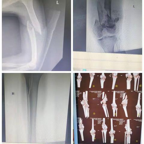 多科室联合协助下多发骨折的治疗彰显南石医院综合实力