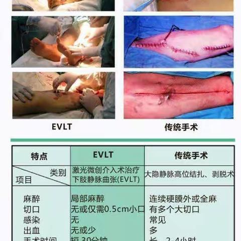 腔内激光微创治疗下肢大隐静脉曲张｜安阳市第二人民医院 普外科