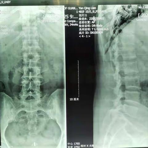 二骨一区5床，严清莲，女，49岁，右臀部、右外踝区、右髂前上棘区疼痛2－3月。病史特点:弯腰诱发原有疼痛，伸腰正常。