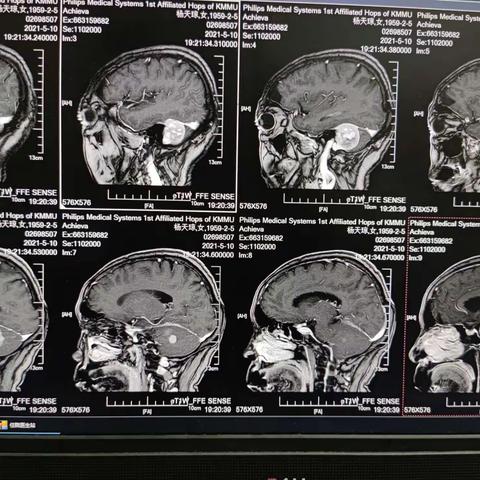 李主任组本部67床术后