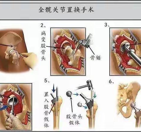 全髖关节置换术—直立行走不再是梦想