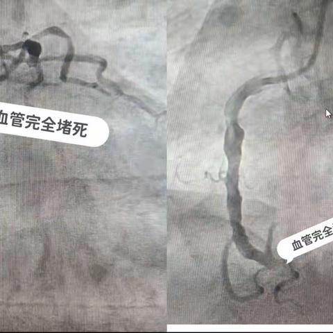 吸烟伤肺，“更伤心”