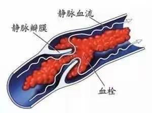 血栓性静脉炎的发病原因及治疗原则