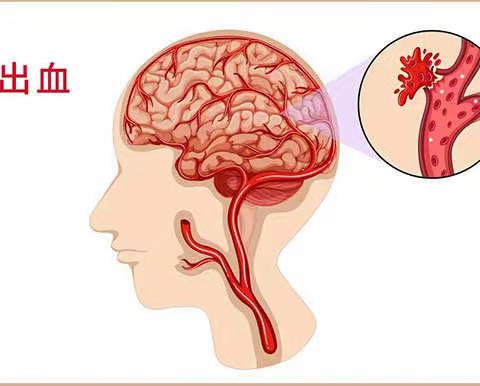 心脑病科与您共同认识脑出血